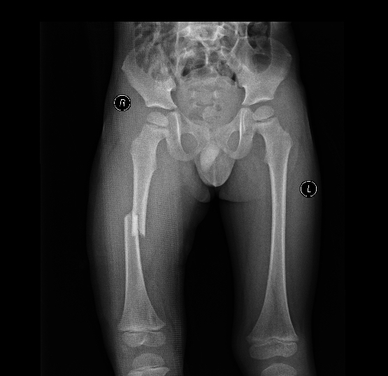 幼儿骨折误区,儿童骨折为什么好得快