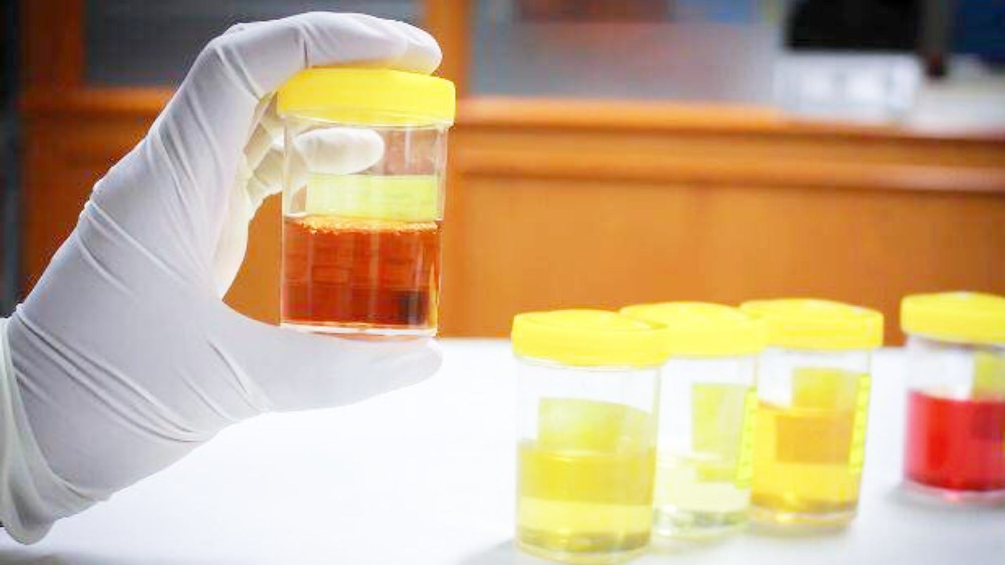 尿糖和糖尿病的区别,尿糖数值多少是糖尿病