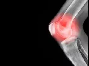 骨友之家|骨刺竟然是“好东西”?原来我们都错怪它了