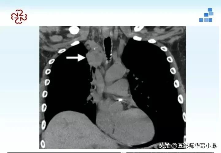 「精品课件」胸部膈肌的解剖及常见病变影像的表现