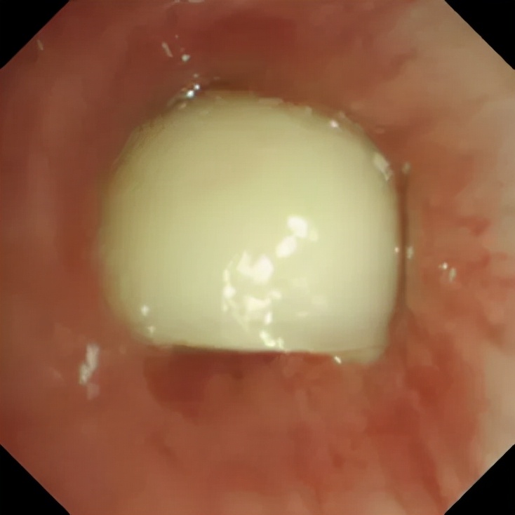气管呛入异物最佳处理方法,呛住气管异物怎么自救