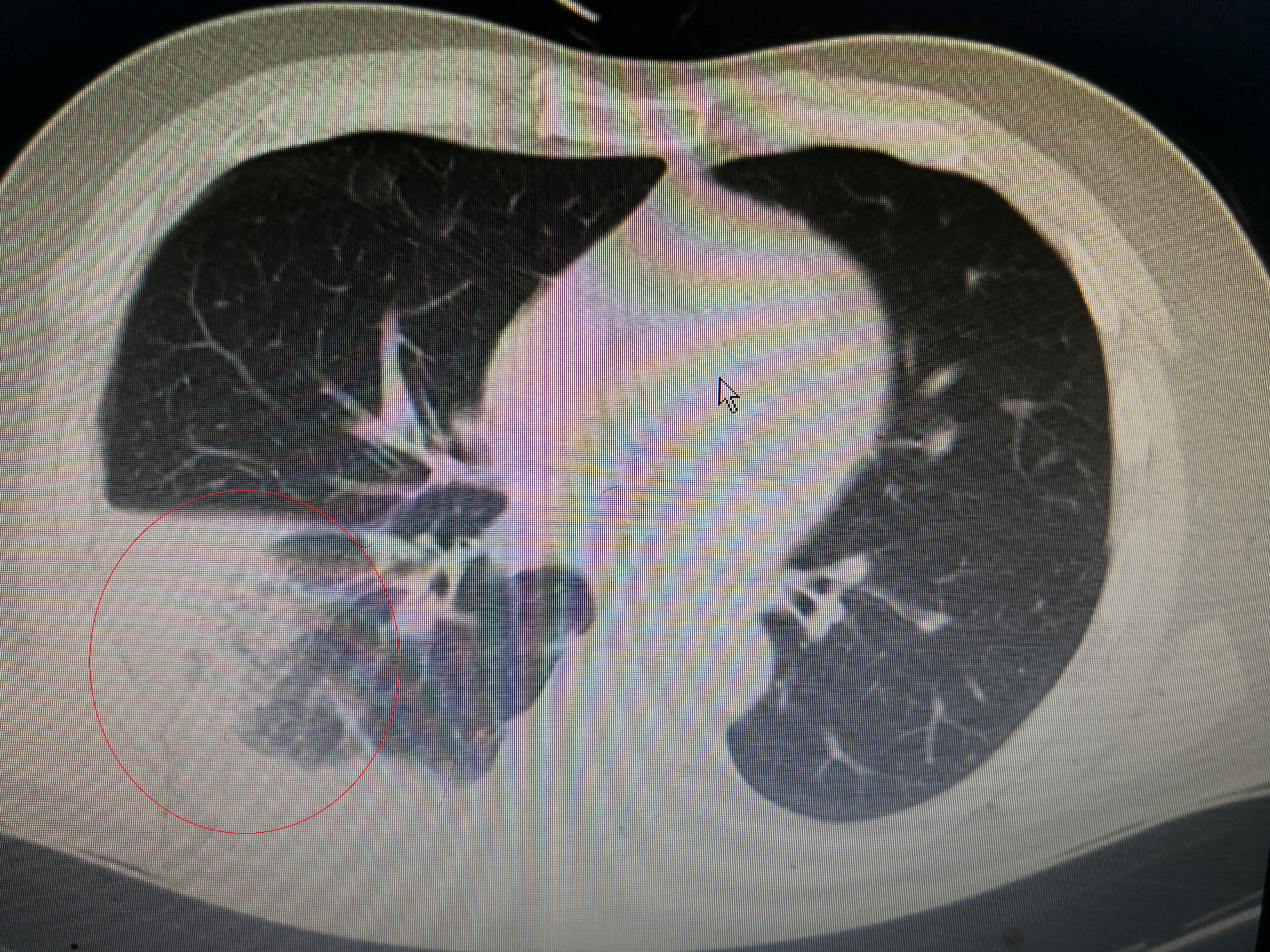 重症肺炎的急救配合要点,重症肺炎针对性护理措施