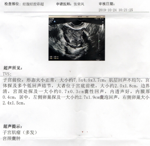 桂枝茯苓丸治疗子宫肌瘤,桂枝茯苓丸治疗子宫肌瘤原理