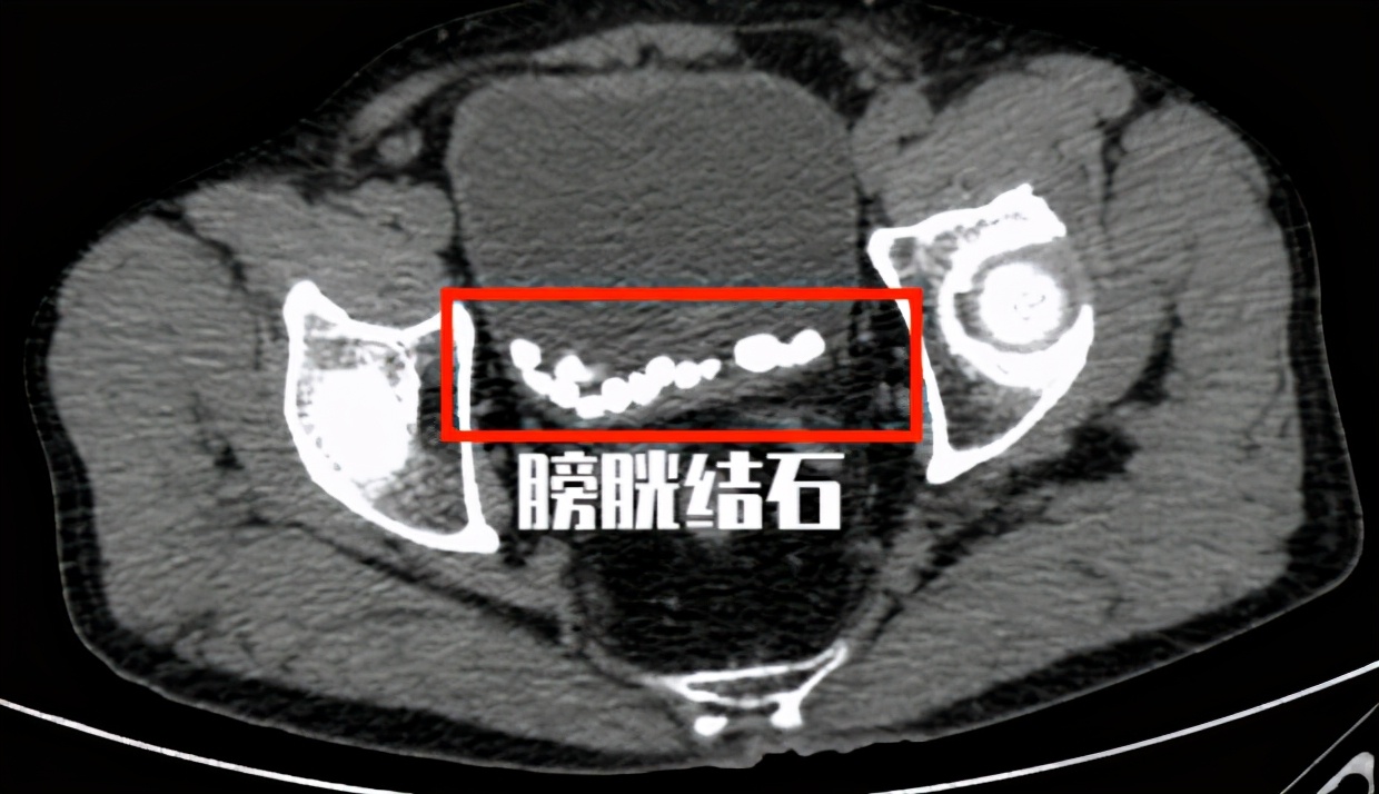 前列腺增生膀胱有余尿如何做手术,前列腺增生是结石吗