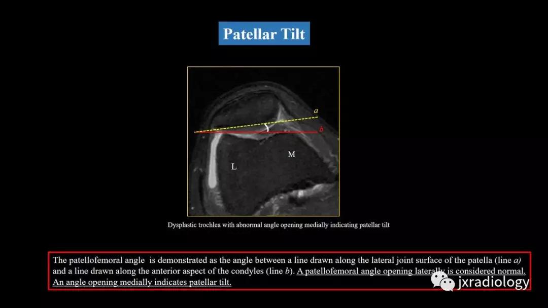 髌股关节失常磁共振看什么,髌股关节混乱的影像评估