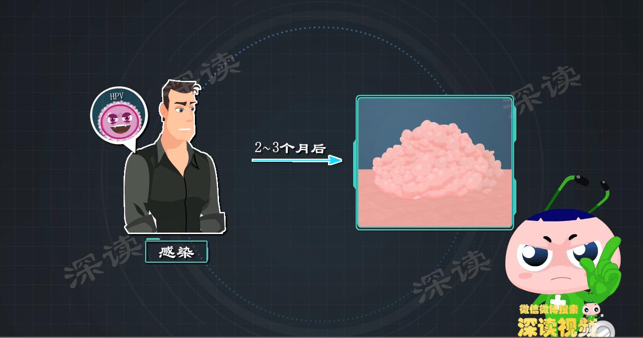 得了hpv一定会长尖锐湿疣吗,小伙口腔长尖锐病毒湿疣