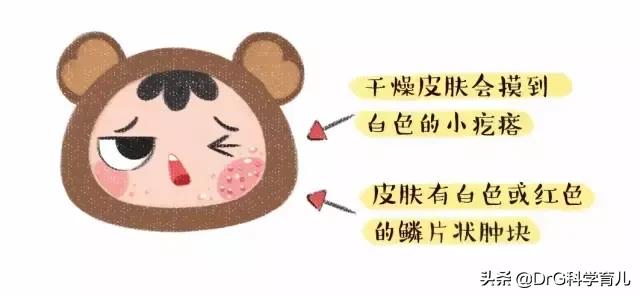 干湿疹为什么会反复的起呢,各种疹子怎么区分