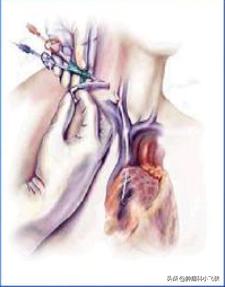 化疗埋管保证治疗顺利进行，一旦药物外渗患者遭罪又耽误治疗