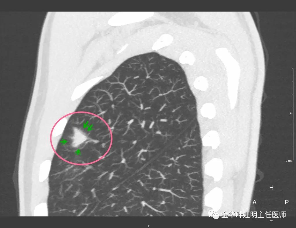 叶建明谈肺结节:一招分辨隐球菌性肉芽肿与肺癌