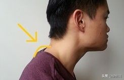 颈椎富贵包怎么消除最有效方法,怎样快速消除颈椎的富贵包