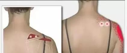 中医怎么看肩膀冈上肌疼痛,肩膀冈上肌疼痛