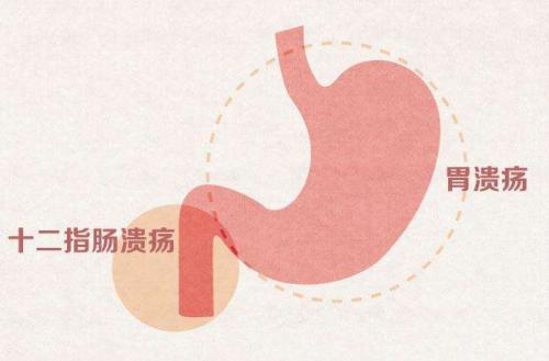 治疗消化性溃疡最好的四联用药,用于治疗消化性溃疡的四大类药物