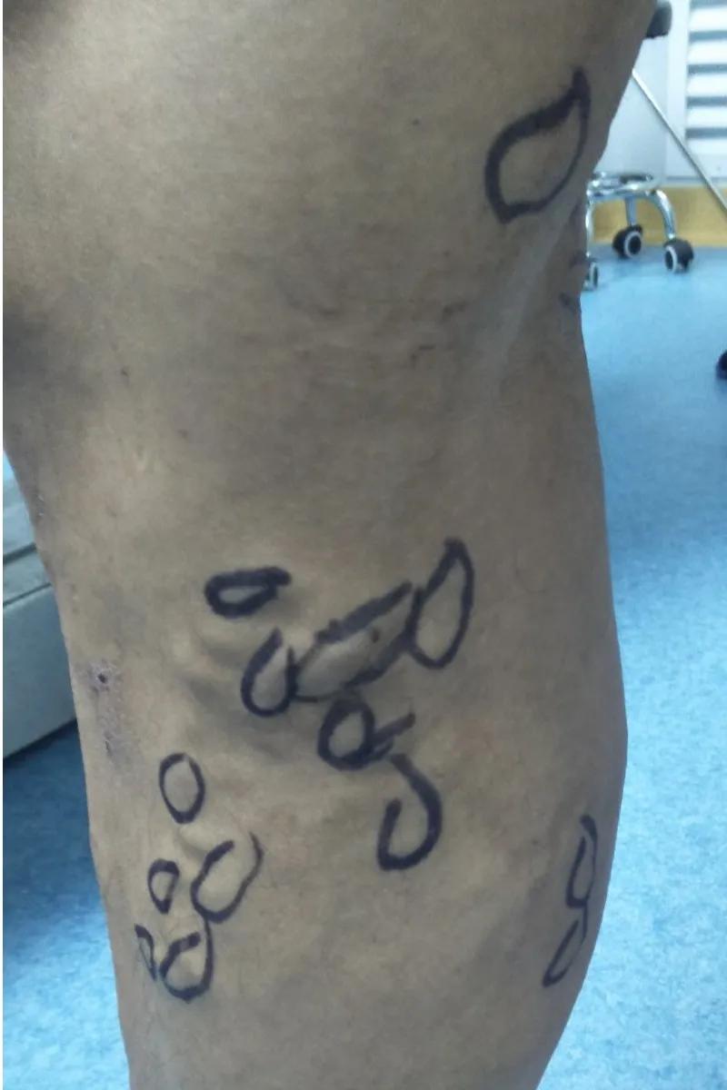 河北静脉曲张微创手术,邢台静脉曲张手术多长时间治好