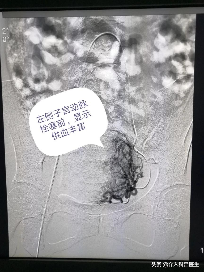 子宫腺肌症中度贫血,女性腺肌症贫血怎么调理