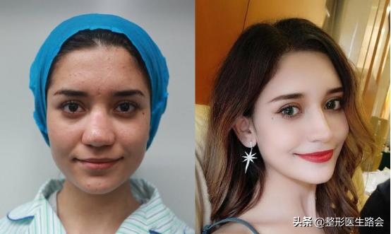 鼻整形手术风险,鼻整形副作用