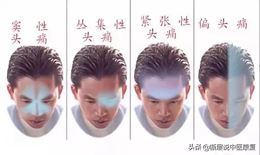 颞部头痛怎么办快速缓解,拉伸颞肌缓解偏头痛