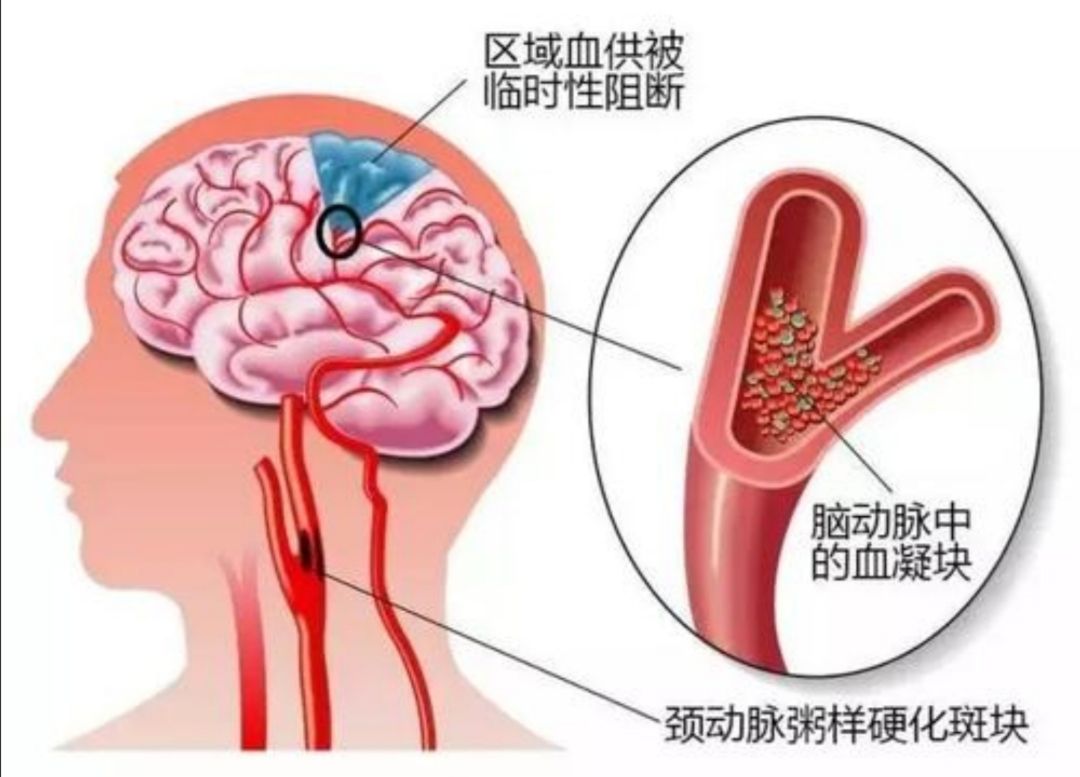 腔隙性脑梗死不吃降压药能治吗,腔隙性脑梗塞能活血吗