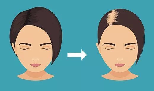 秃顶这件事就过不去了?两项新研究为治疗脱发带来新希望