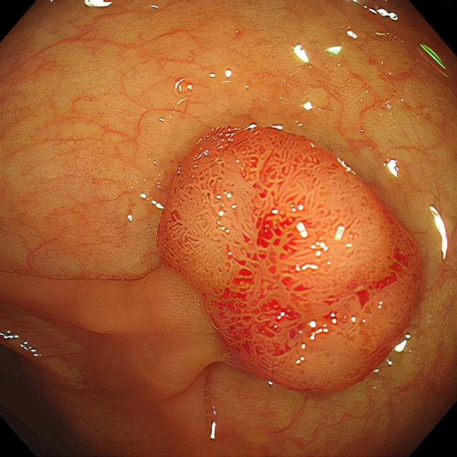 胃肠息肉是癌吗,长了结肠息肉会有什么症状