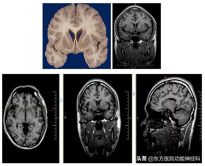 精神病人的前世,精神科药物的前世今生