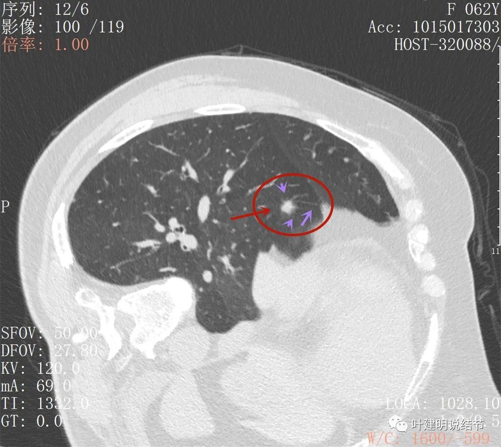 左肺癌手术半年右肺下角还有炎症,左下肺癌晚期