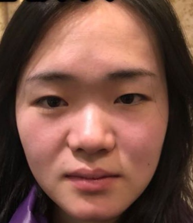 嘴凸鼻基底凹陷法令纹练背有用吗,鼻基底凹陷填充后对法令纹有改善