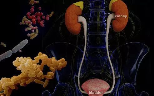尿路感染最常见的病菌,最常见的尿路感染疾病