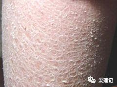 去除手上鸡皮,去除手臂上的鸡皮肤