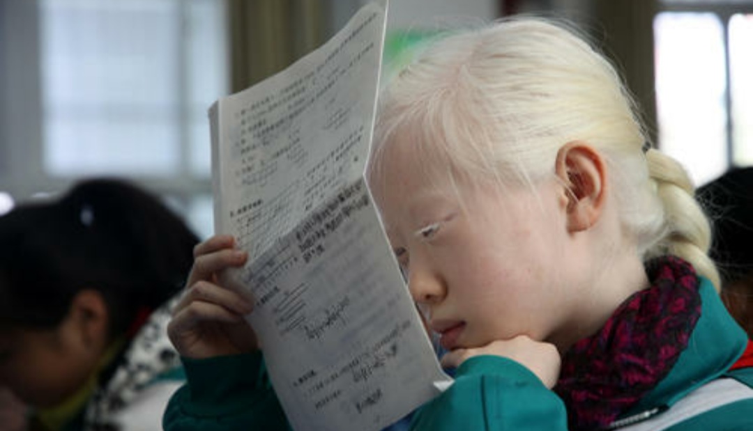 缺少黑色素但不是白化病,体内黑色素过少会引起白化病吗