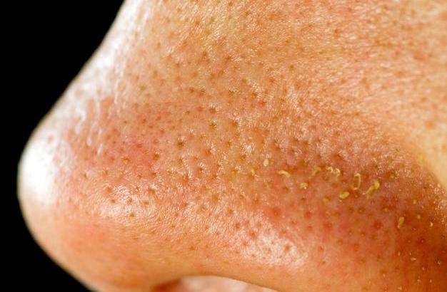 脸颊两边有螨虫用什么东西,螨虫在脸上分泌的物体