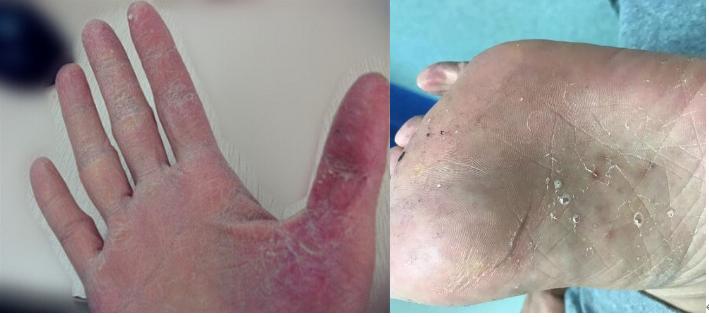 梅毒伪装,伪装者罪行