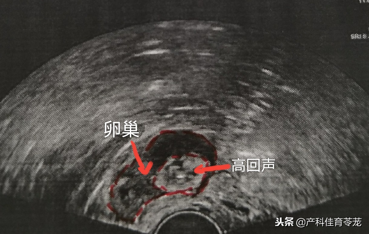 做b超能看见卵巢吗,妇科b超结果显示卵巢什么意思