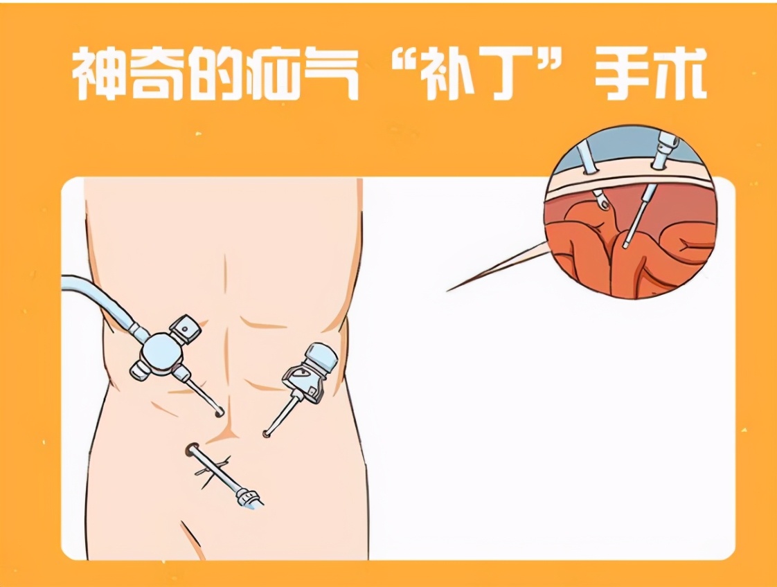 腹部手术后如何预防切口疝,腹部疝气手术并发症