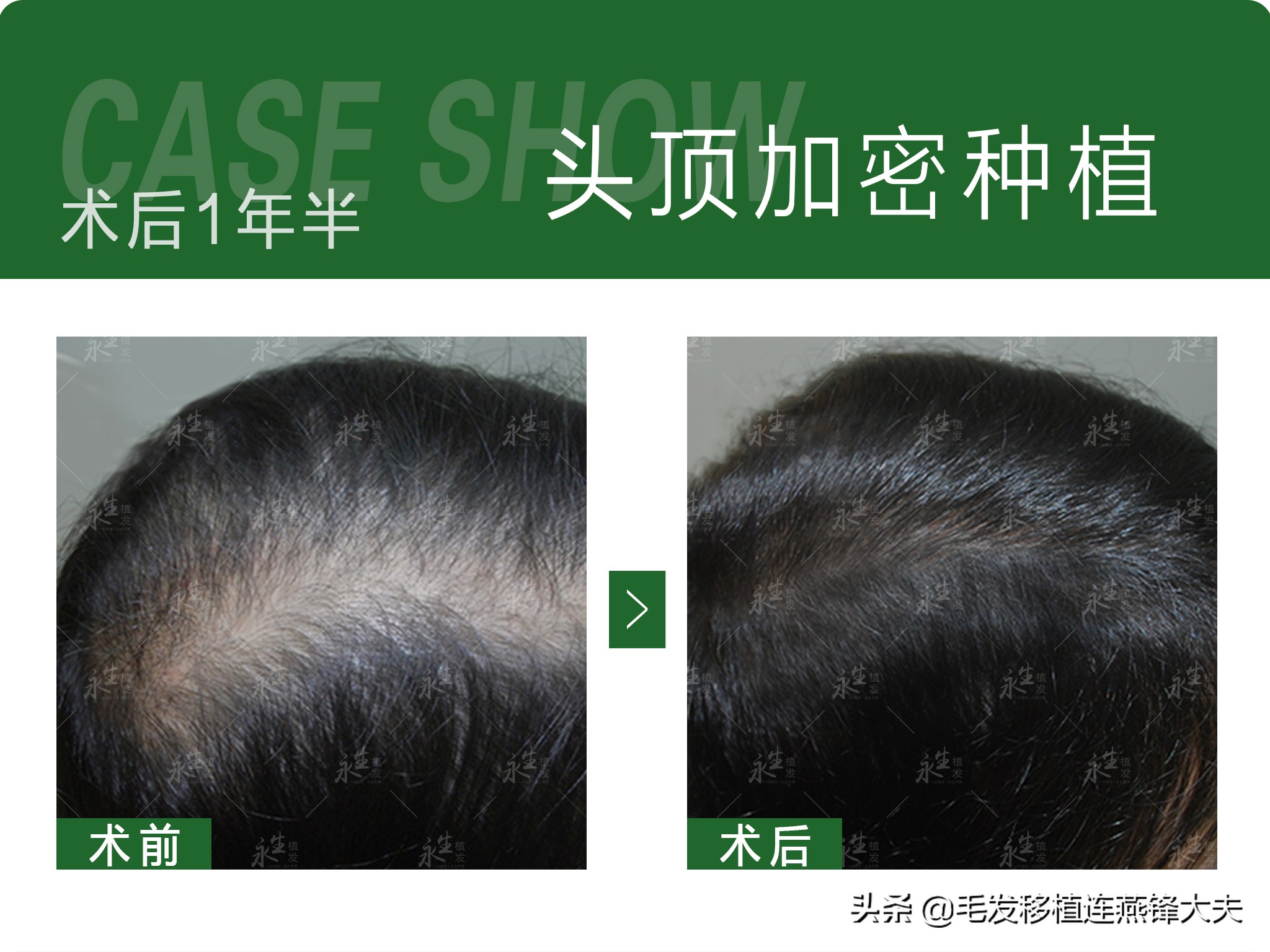 米诺地尔治疗男性脱发有效果吗,米诺地尔治疗脱发