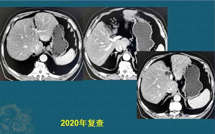 分享癌症患者康复,肿瘤病人的分享