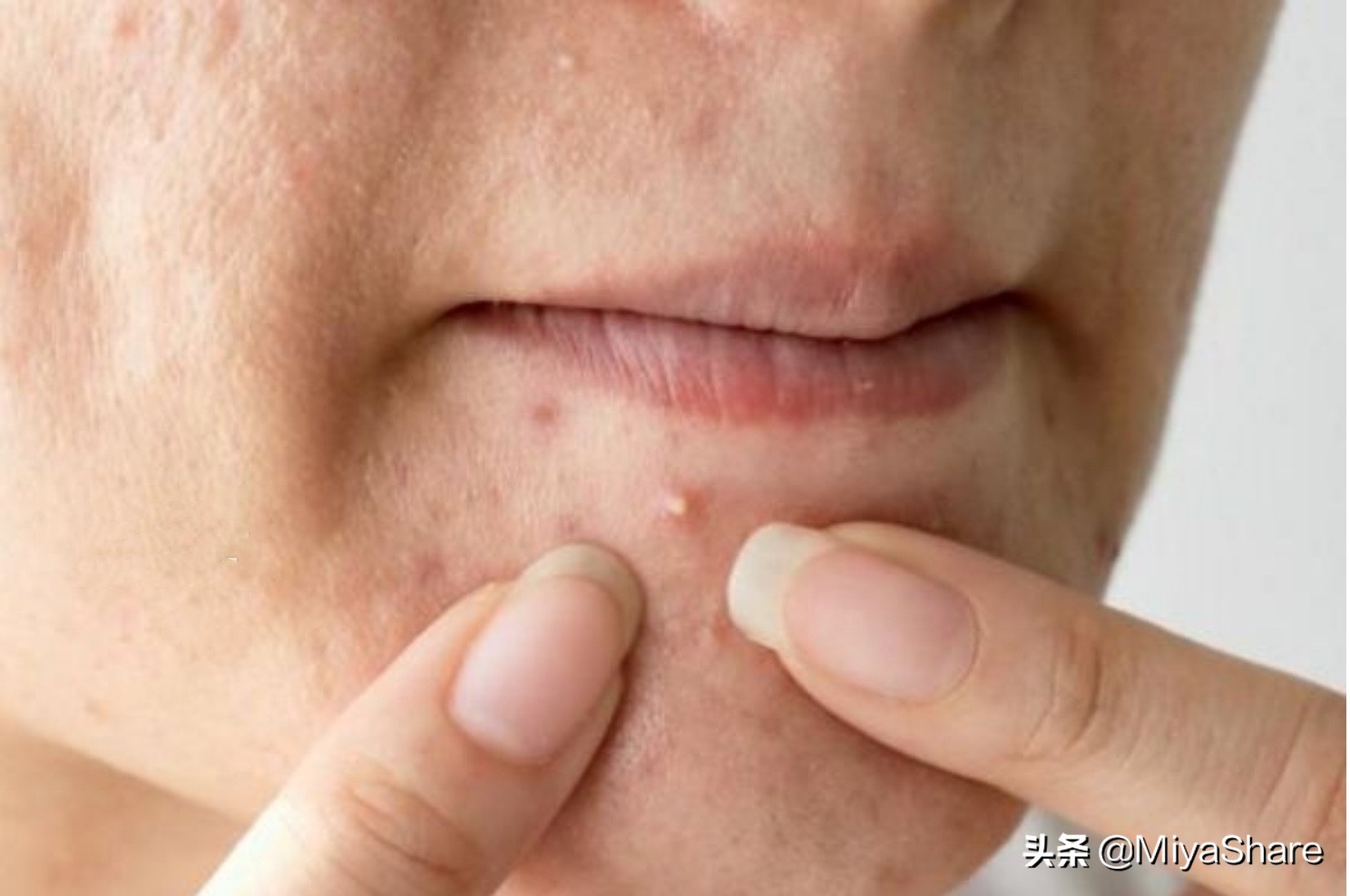 长痘后如何正确处理,长痘之后如何去红