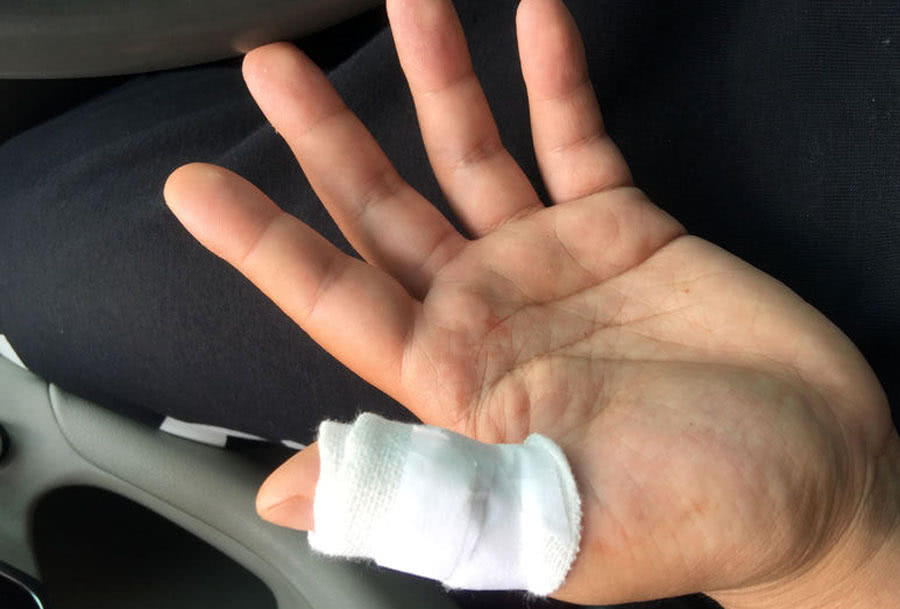 钓鱼时被刺到,为什么每次钓鱼都会被鱼钩伤到