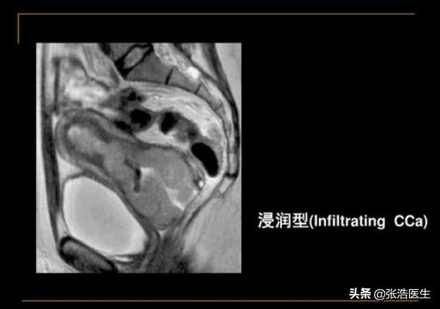 早期宫颈癌会转移成肺癌吗,宫颈癌转移至胸椎能治好吗