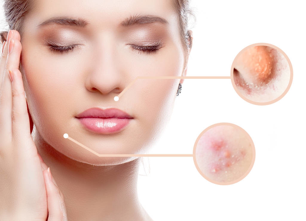 适合学生党的快速祛痘痘方法,熬夜脸上长痘痘中药治疗