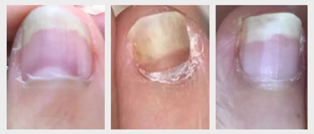 孙叔公治灰指甲有效吗,孙叔公治甲周疣有用吗