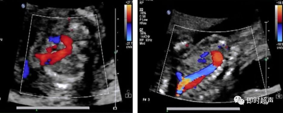 胎儿心脏三种血管关系模式图,25周的胎儿心脏弓切面多少正常