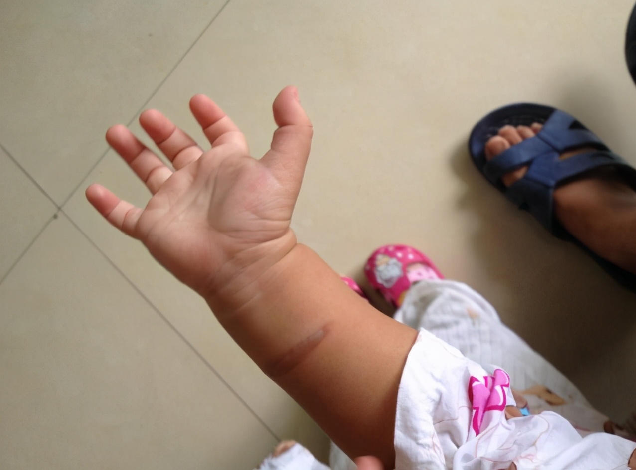 小孩被烫伤家人急救措施,孩子被烫伤家长应该怎么处理