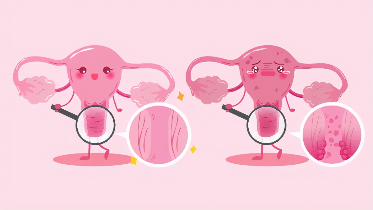 得了子宫内膜癌有什么征兆,子宫内膜癌最常见的表现是什么呢