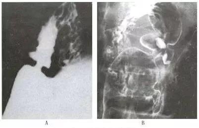 十二指肠球部溃疡解剖位置,十二指肠球部溃疡x线表现