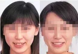 怎么才能真正有效的美白牙齿,最快最有效美白牙齿的方法