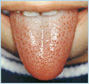 中医看舌头知病情图片,看舌头知病情图解大全