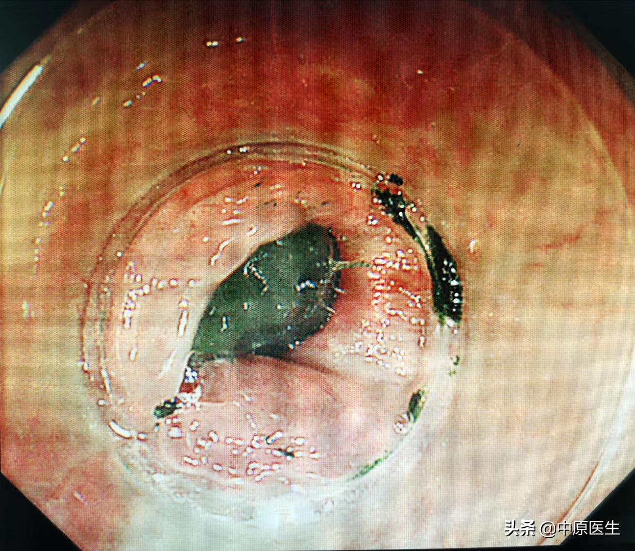 老人吃饭被骨头卡喉咙用什么药,老人被一粒饭卡喉咙