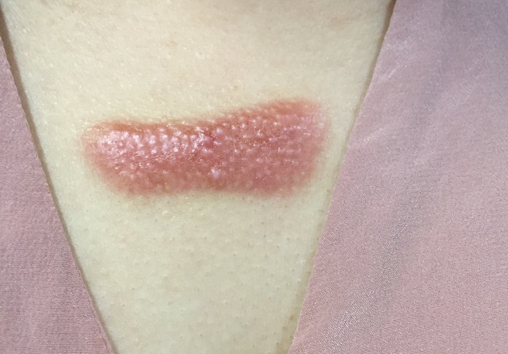 疤痕增生变软了是快好了吗,增生疤变软