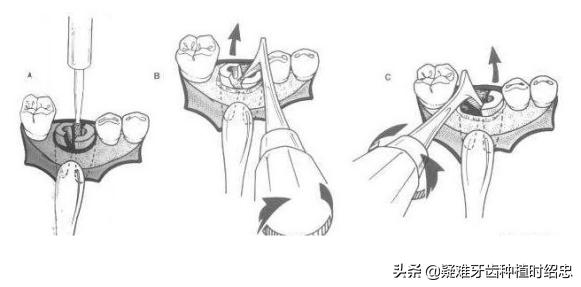 孩子牙只剩残根怎么换牙,只剩残根的牙真的能补救吗