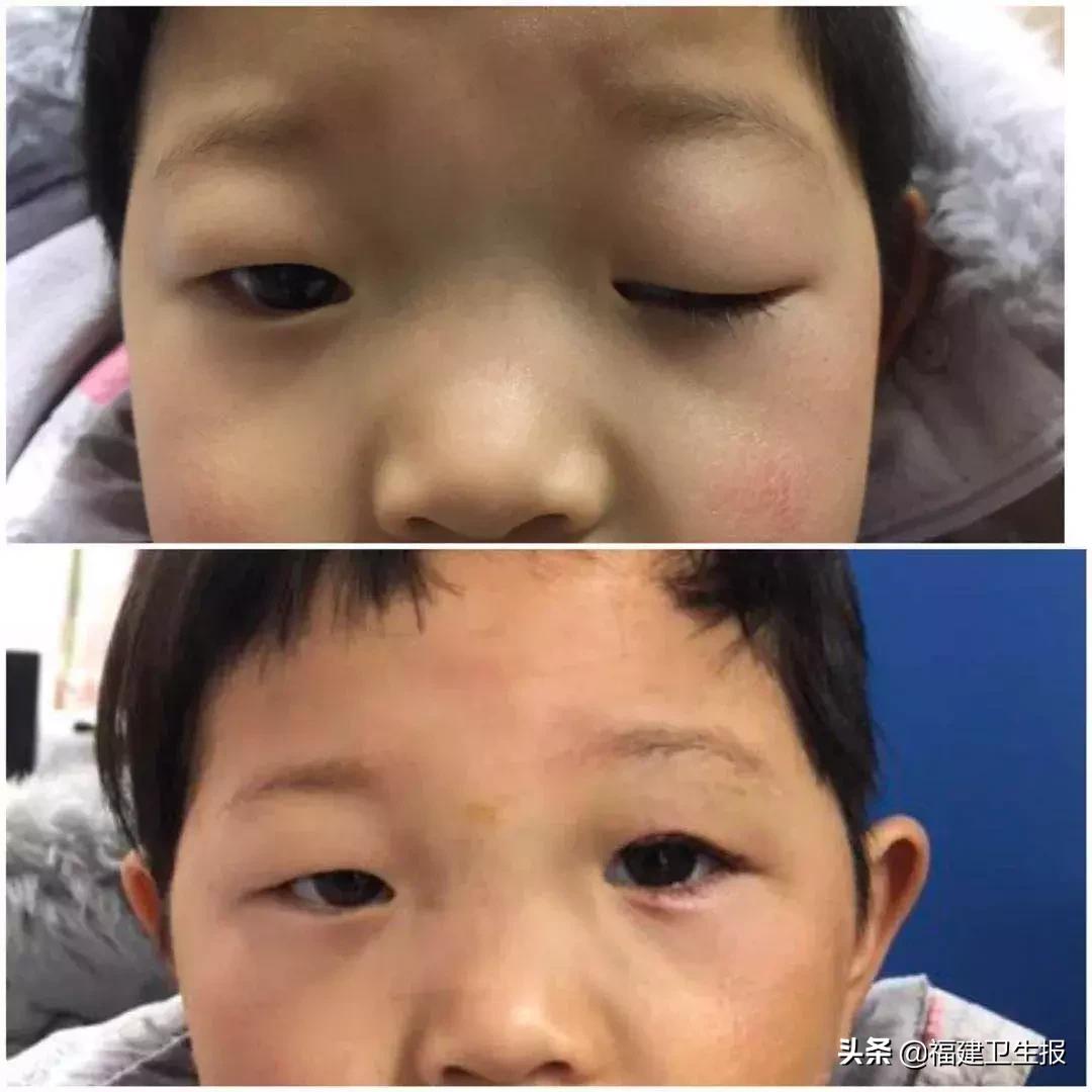 6岁女孩眼睛看不见了,六岁女孩眼睛看不见了